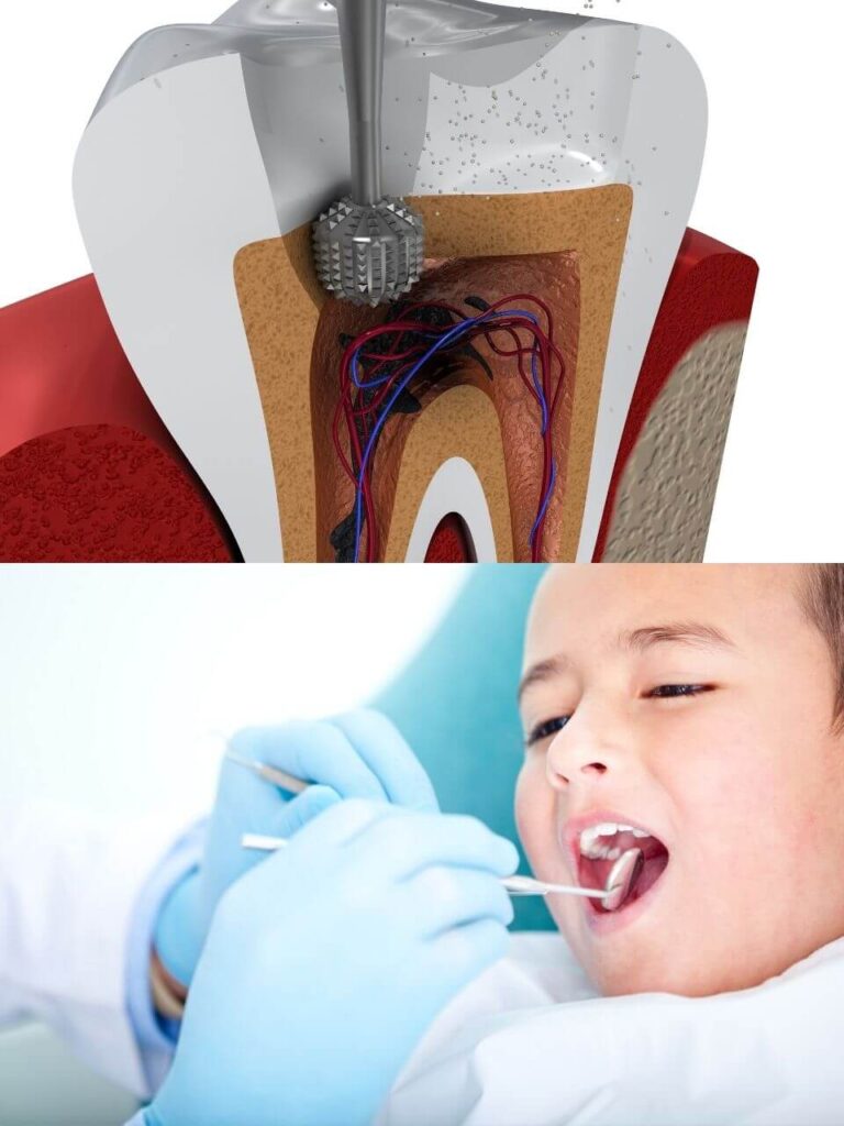  Pulpectomy / Root canal treatment 