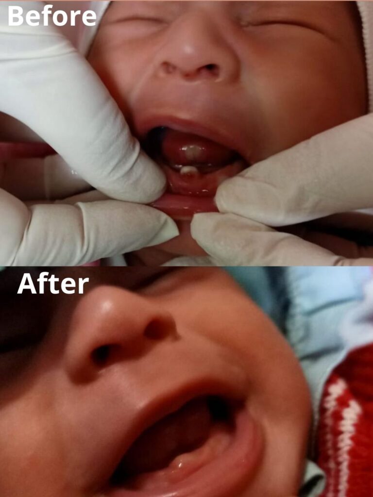 Neonatal tooth extraction