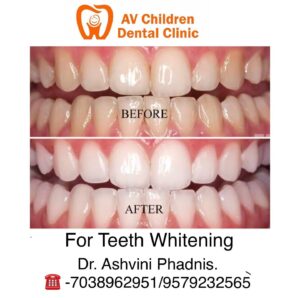 Teeth Whitening - AV Dental clinic