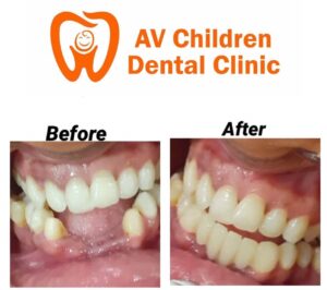 before after treatment - AV Children and Multispeciality clinic