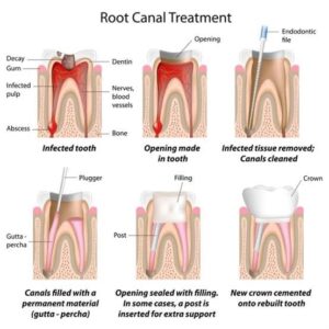 Root canal treatment or RCT